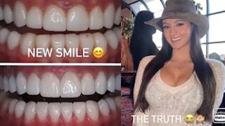 My 70 thousand dollar smile and the TRUTH about ￼Bulimia / VENEERS