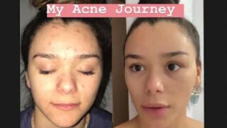 MY ACCUTANE JOURNEY (how I got rid of my acne)